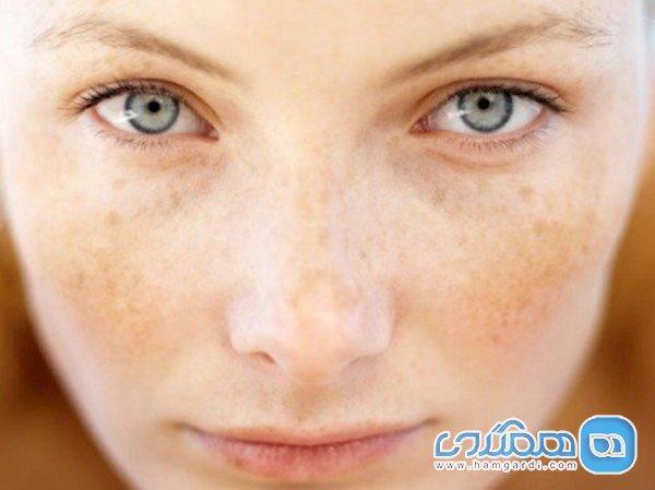 روش های پیشگیری از خال صورت