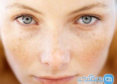 روش های پیشگیری از خال صورت