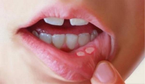 چگونه با روش های خانگی آفت دهان را سریع درمان کنیم؟