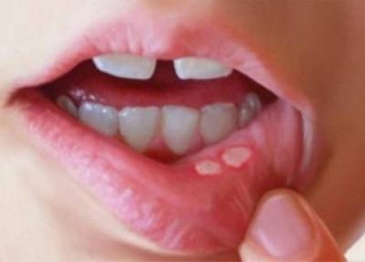 چگونه با روش های خانگی آفت دهان را سریع درمان کنیم؟